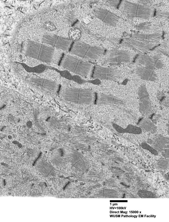 27A1 Muscle Bx(Case 27)_001 - Copy