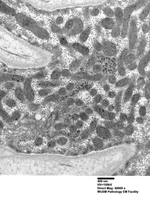 28A1C (Case 28) muscle_035 - Copy