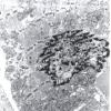 2A1 Mitochondrial Myopathy (Case 2) EM 1 - Copy