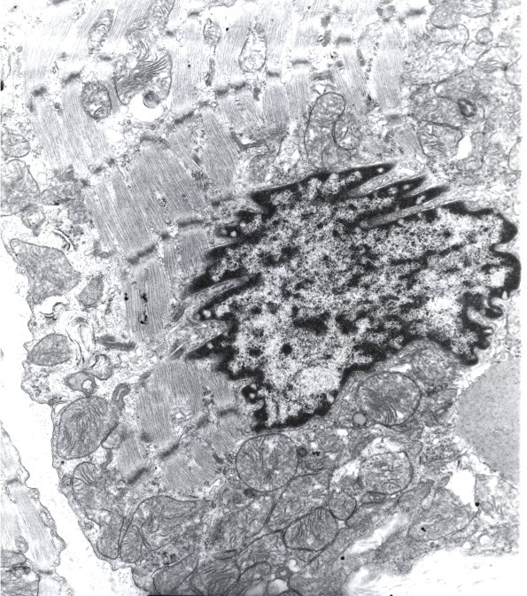 2A1 Mitochondrial Myopathy (Case 2) EM 1 - Copy