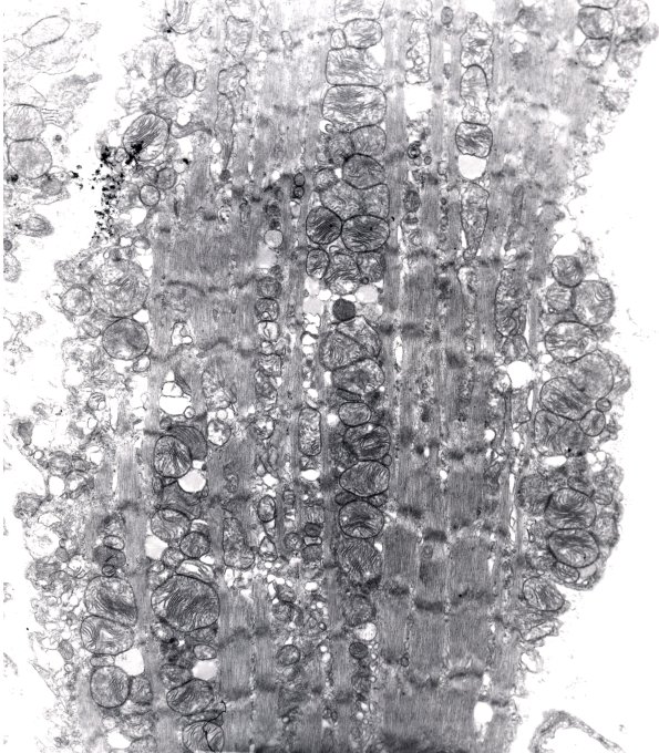 2A2 Mitochondrial Myopathy (Case 2) EM 3 - Copy