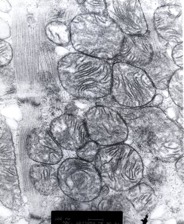2A3 Mitochondrial Myopathy (Case 2) EM 2 - Copy