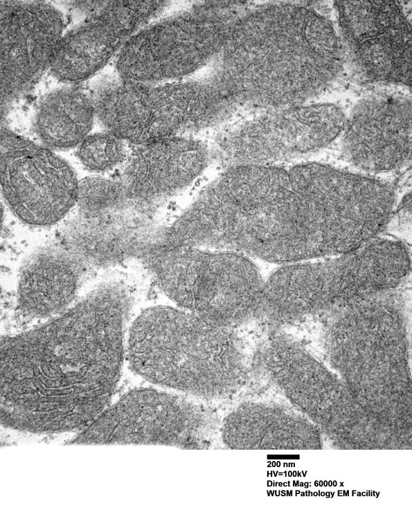 30A1C (Case 30) muscle_018 - CopyA