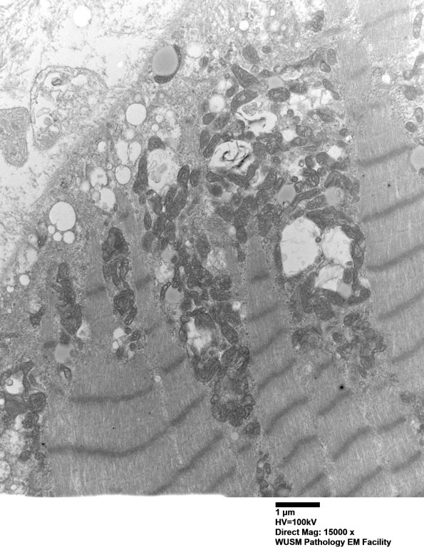36A1 (Case 36) Cervical Paraspinal_012 - Copy