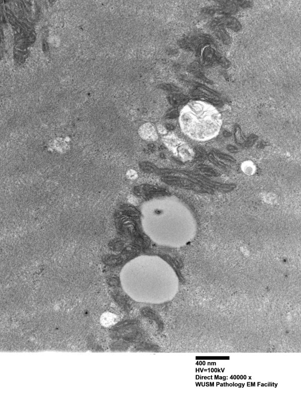 36A2 (Case 36) Cervical Paraspinal_005 - Copy