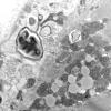 36A4 (Case 36)Cervical Paraspinal_024 - Copy