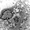 36A5 (Case 36) Cervical Paraspinal_025 - Copy