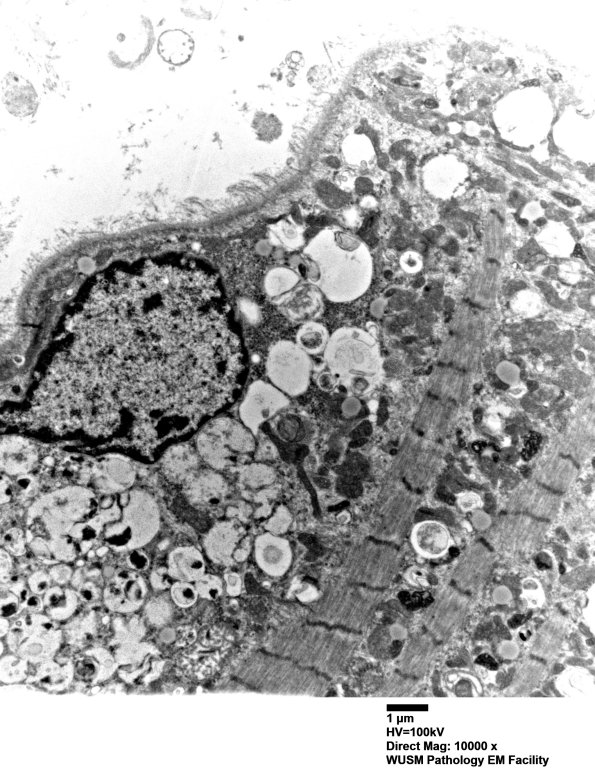 36A5 (Case 36) Cervical Paraspinal_025 - Copy