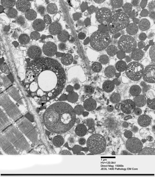 3B1B Mitochondrial myopathy (Case 3)_003 - Copy