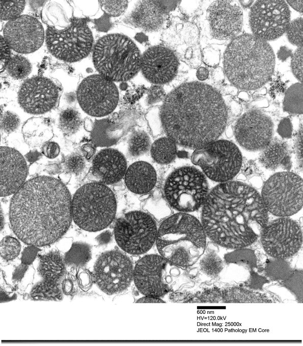 3B1C Mitochondrial myopathy (Case 3)_005 - Copy
