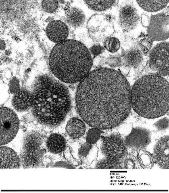 3B1D Mitochondrial myopathy (Case 3)_006 - Copy