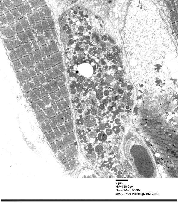 3B2A Mitochondrial myopathy (Case 3)_007 - Copy