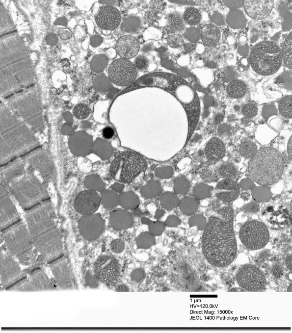 3B2B Mitochondrial myopathy (Case 3)_010 - Copy