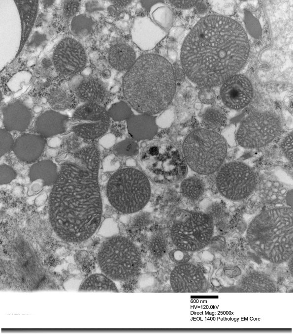 3B2C Mitochondrial myopathy (Case 3)_012 - Copy