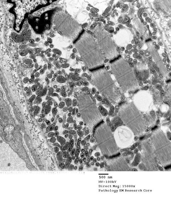 3B3B Mitochondrial Myopathy, unclassified (Case 3) EM 010 - Copy