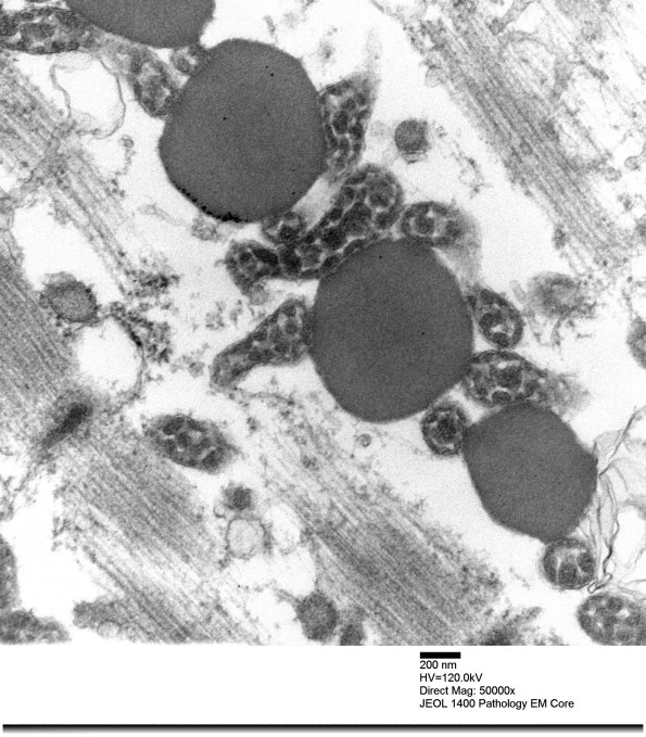 3B3E Mitochondrial myopathy (Case 3)_016 - Copy