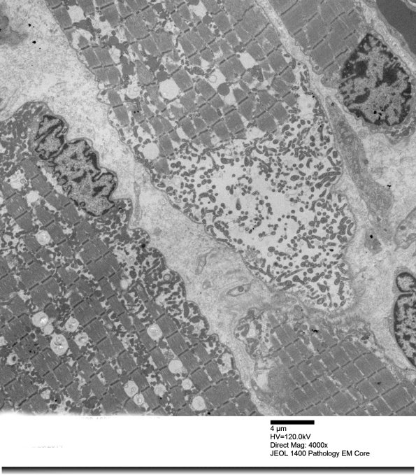 3B4A Mitochondrial myopathy (Case 3)_017 - Copy