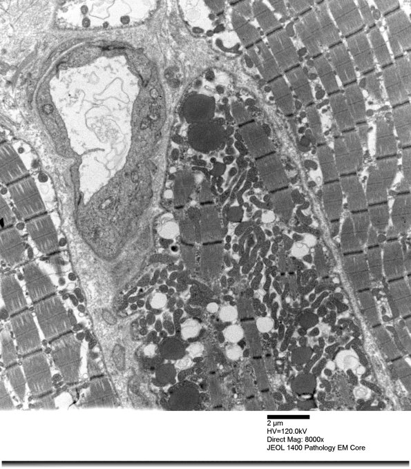 3B5A Mitochondrial myopathy (Case 3)_021 - Copy
