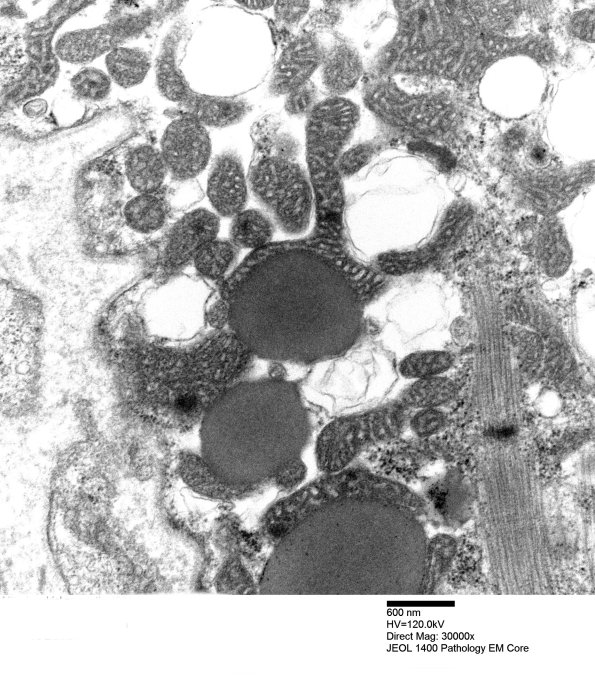 3B5C Mitochondrial myopathy (Case 3)_024 - Copy