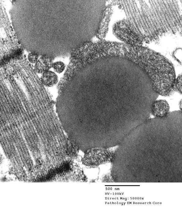 3B5F Mitochondrial myopathy (Case 3 EM015 - Copy