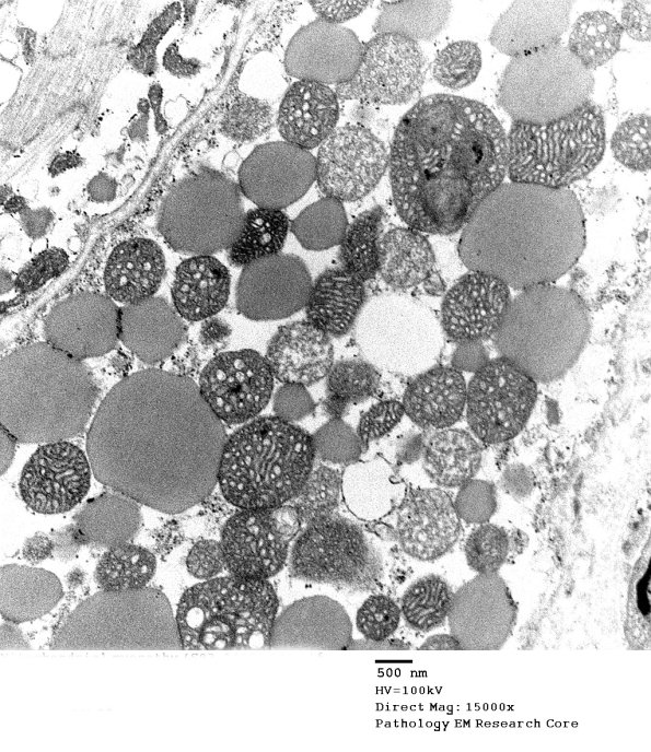 3B6A Mitochondrial myopathy (Case 3 EM002 - Copy