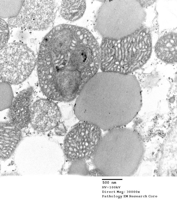 3B6B Mitochondrial Myopathy (Case 3 EM00X - Copy