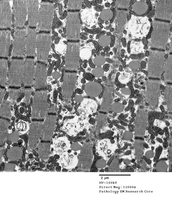 3B7A Mitochondrial myopathy (Case 3 EM005 - Copy