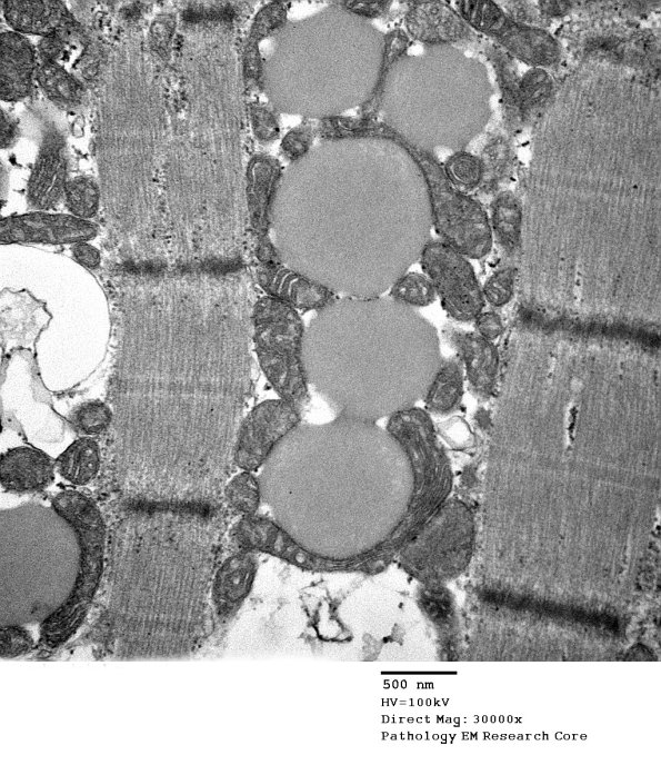 3B7B Mitochondrial myopathy (Case 3 EM006 - Copy