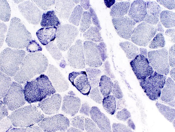 4D Mitochondrial myopathy MNGIE (Case 4) SDH-20x