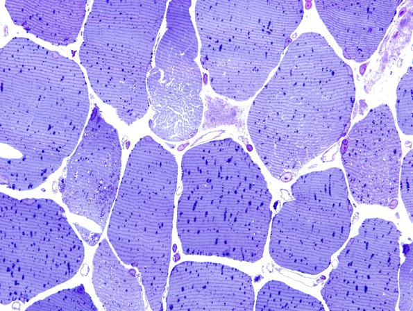 4E1Mitochondrial-myopathy-MNGIE-Case-4-Plastic-3.jpg