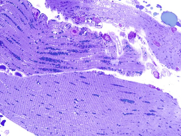 4E2-Mitochondrial-myopathy-MNGIE-Case-4-Plastic-6.jpg