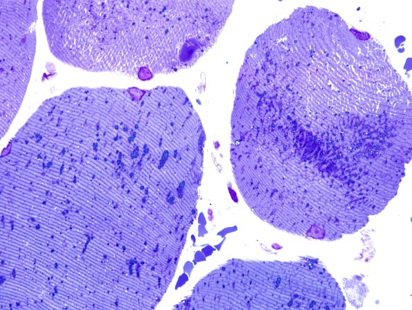 4E3Mitochondrial-myopathy-MNGIE-Case-4-Plastic-5.jpg