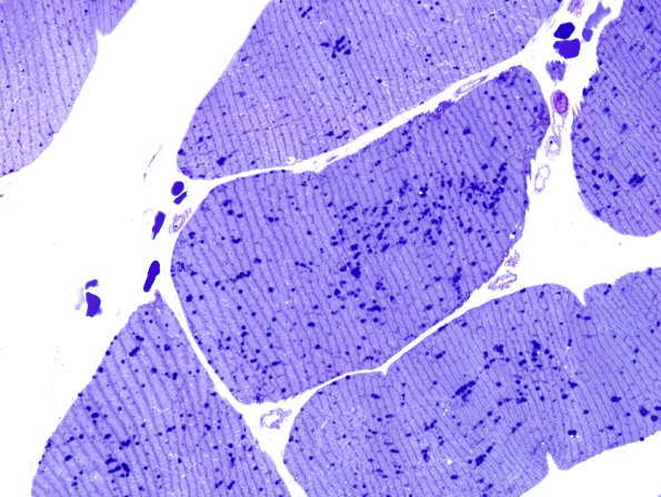 4E4Mitochondrial-myopathy-MNGIE-Case-4-Plastic-4.jpg