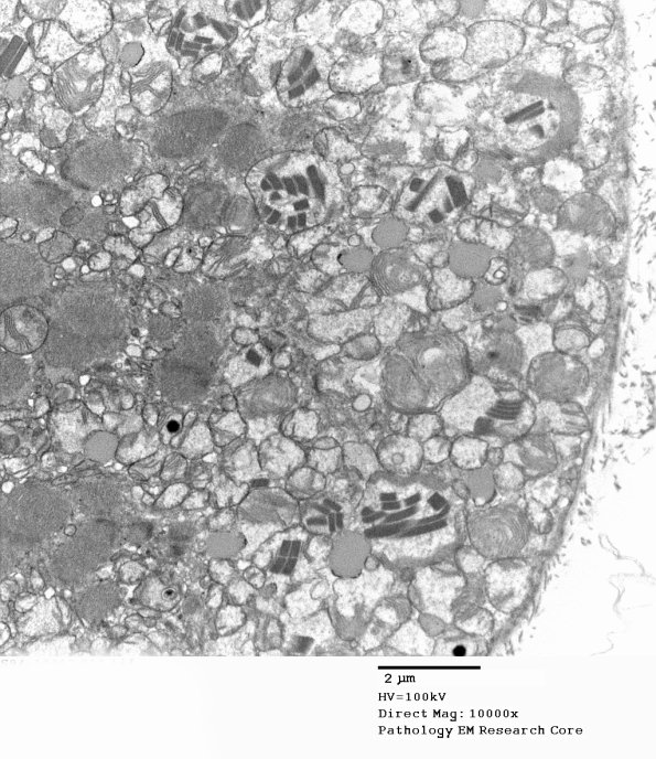 4F1A1 Mitochondrial myopathy (Case 4) EM 012 - Copy