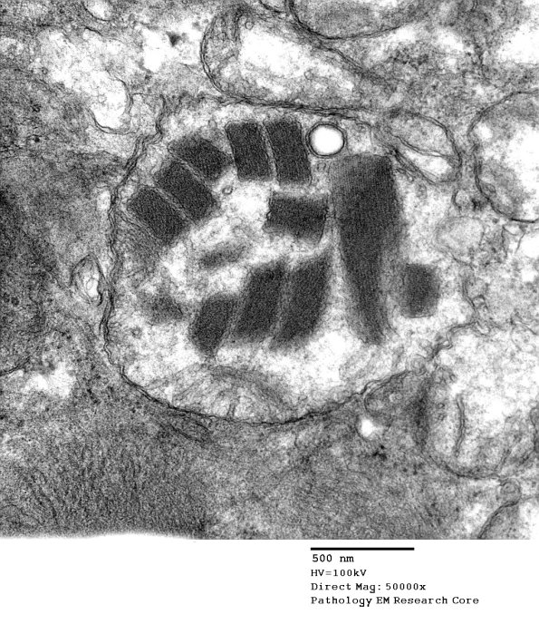 4F1B Mitochondrial myopathy (Case 4) EM 003 - Copy