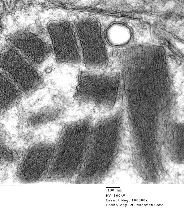4F1C Mitochondrial myopathy MNGIE (Case 4) EM 004 - Copy