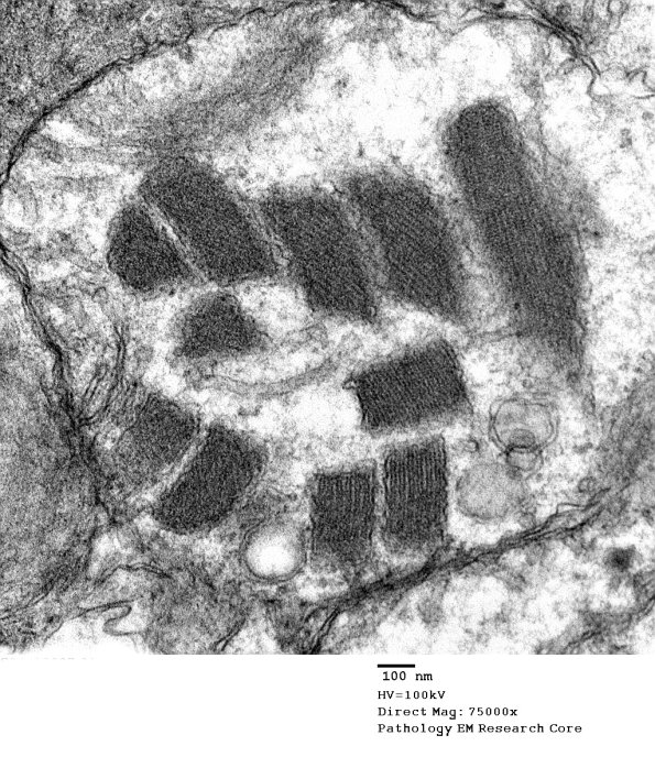 4F1E Mitochondrial myopathy (Case 4) EM 015 - Copy