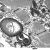 4F2A Mitochondrial myopathy MNGIE (Case 4) EM 007 - Copy