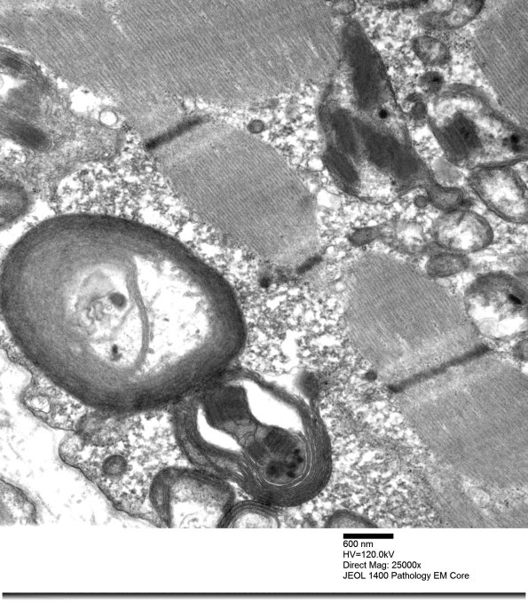 4F2A Mitochondrial myopathy MNGIE (Case 4) EM 007 - Copy