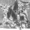 4F2D Mitochondrial myopathy MNGIE (Case 4) EM 005 (2) - Copy