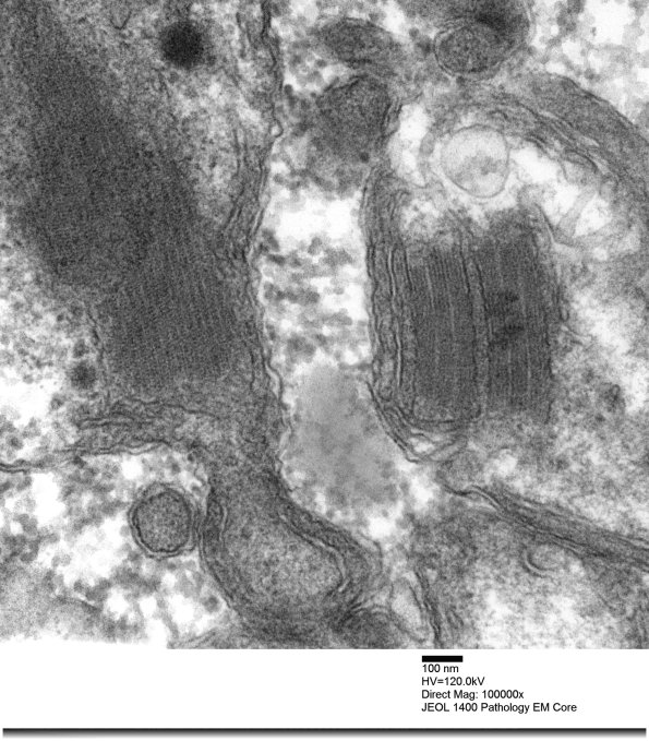 4F2E Mitochondrial myopathy MNGIE (Case 4) EM 006 - Copy