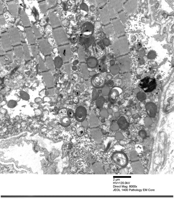 4F3A Mitochondrial myopathy MNGIE (Case 4) EM 008 - Copy