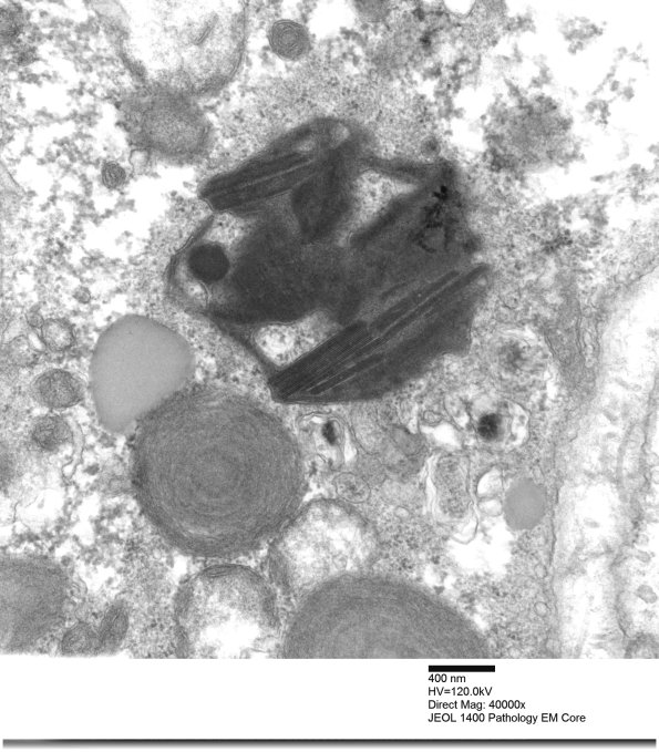 4F3B Mitochondrial myopathy MNGIE (Case 4) EM 009 - Copy
