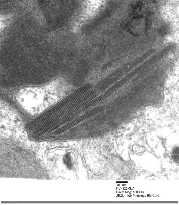 4F3C Mitochondrial myopathy MNGIE (Case 4) EM 010 - Copy