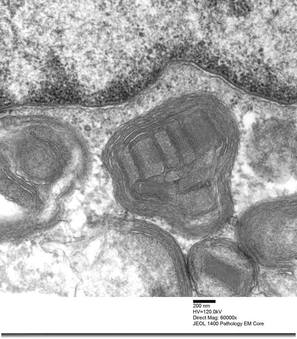 4F4 Mitochondrial myopathy MNGIE (Case 4) EM 014 - Copy