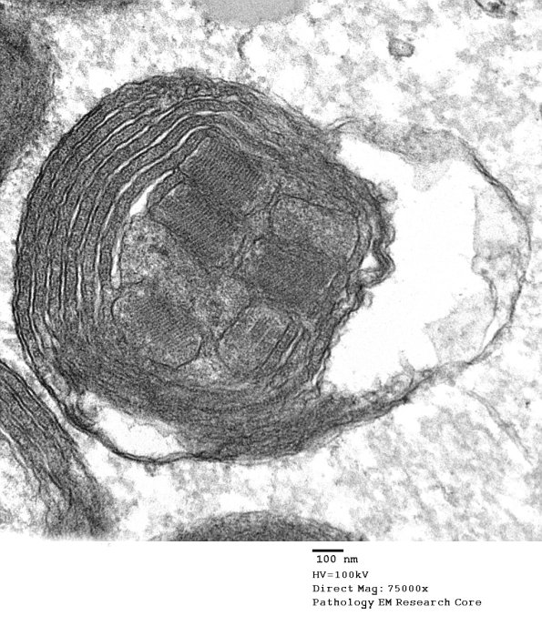 4F5B Mitochondrial myopathy MNGIE (Case 4) EM 026 - Copy