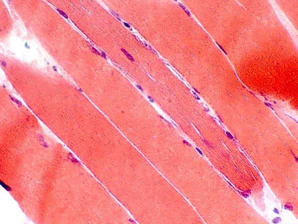 5AMitochondrial myopathy TWINKLE (Case 5) HE-40