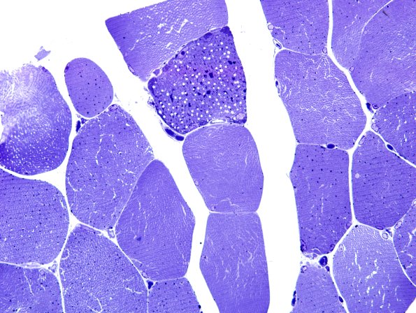 5E1-Mitochondrial-myopathy-TWINKLE-Case-5-Plastic-1.jpg