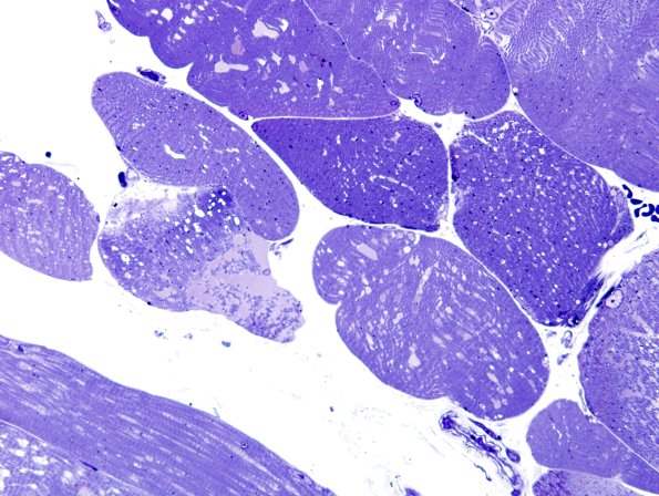 5E2-Mitochondrial-myopathy-TWINKLE-Case-5-Plastic-2.jpg