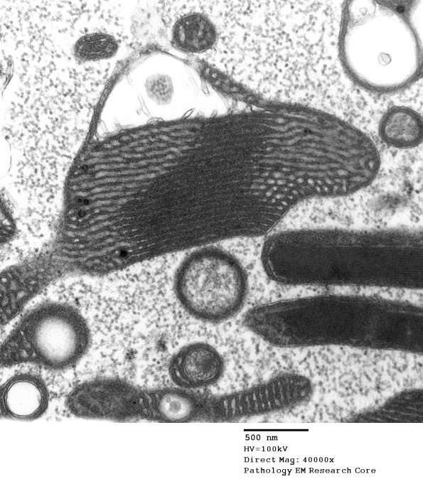 5F2C Mitochondrial myopathy TWINKLE (Case 5) EM 033 - Copy